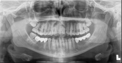 X-Ray for Individual Teeth