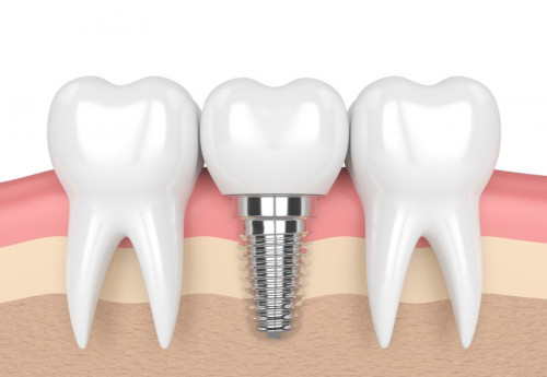 Teeth Implant